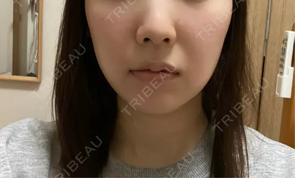 ボトックス（エラ・小顔） ルラ美容クリニック 名古屋本院 DAY 8 メイン用