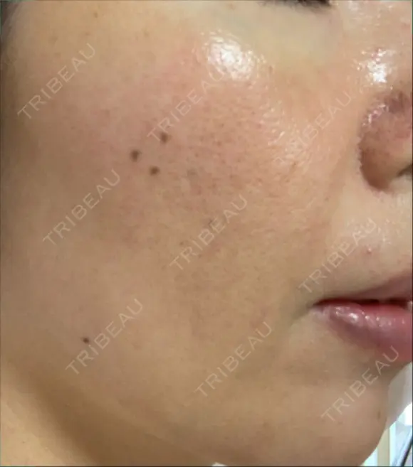 その他（肌） / ダーマペン スキンリファインクリニック銀座 DAY 3 メイン用