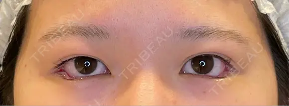 目尻切開 / タレ目形成・グラマラスライン（埋没） LOUIS CLINIC 二子玉川院【ルイクリニック】 DAY 0 メイン用