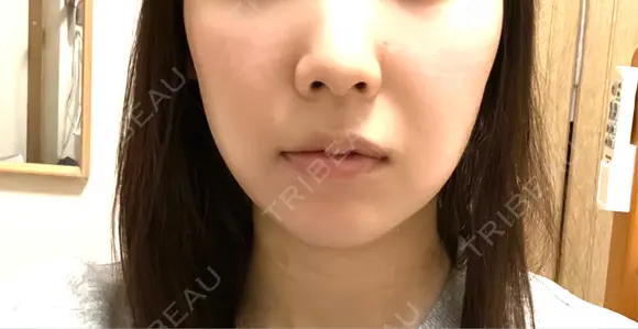 脂肪吸引（顔） ルラ美容クリニック 名古屋栄院 / ルラスキンクリニック 名古屋栄院 DAY 10 メイン用