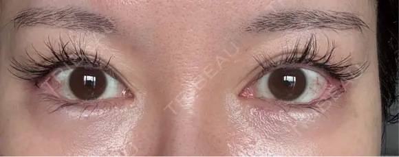 目尻切開 / タレ目形成・グラマラスライン（埋没） / 美容点滴・美容注射（美肌） LOUIS CLINIC 二子玉川院【ルイクリニック】 DAY 3 メイン用