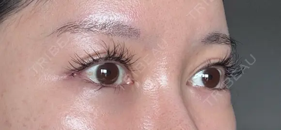 目尻切開 / タレ目形成・グラマラスライン（埋没） / 美容点滴・美容注射（美肌） LOUIS CLINIC 二子玉川院【ルイクリニック】 DAY 3 メイン用