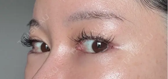 目尻切開 / タレ目形成・グラマラスライン（埋没） / 美容点滴・美容注射（美肌） LOUIS CLINIC 二子玉川院【ルイクリニック】 DAY 3 メイン用