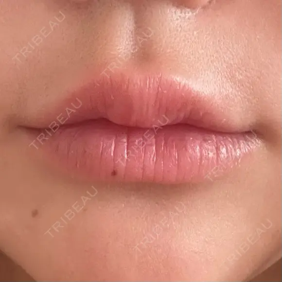 ヒアルロン酸注入（唇） / ボトックス（タレ目） / ボトックス（人中） アネシス美容クリニック AFTER メイン用