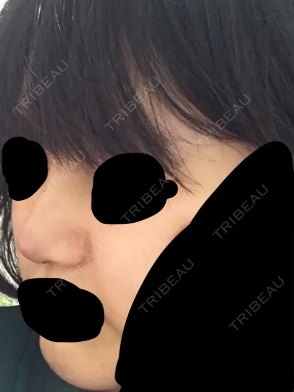 鼻尖形成（切開） 三輪皮フ科形成外科 DAY 6 メイン用