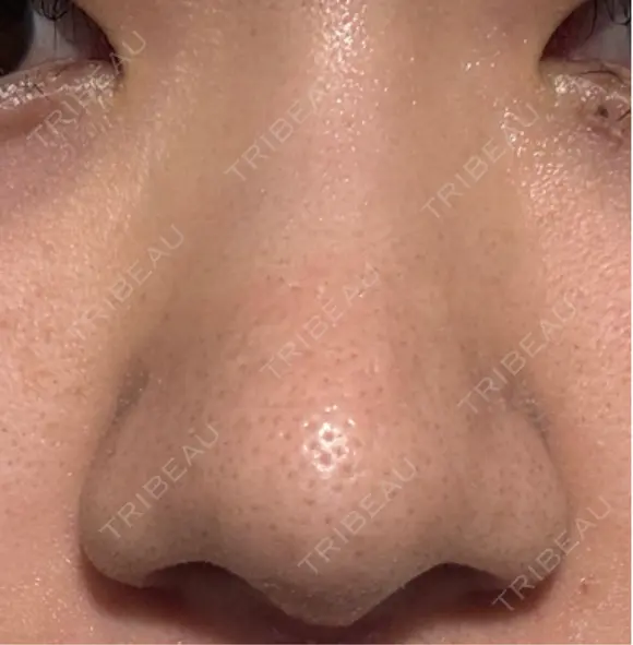 鼻尖形成（切開） / 軟骨移植 / 鼻柱下降・鼻唇角形成（猫手術） 東京美専クリニック DAY 12 メイン用