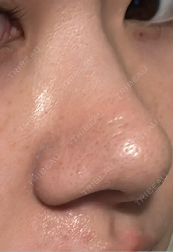 鼻尖形成（切開） / 軟骨移植 / 鼻柱下降・鼻唇角形成（猫手術） 東京美専クリニック DAY 12 メイン用