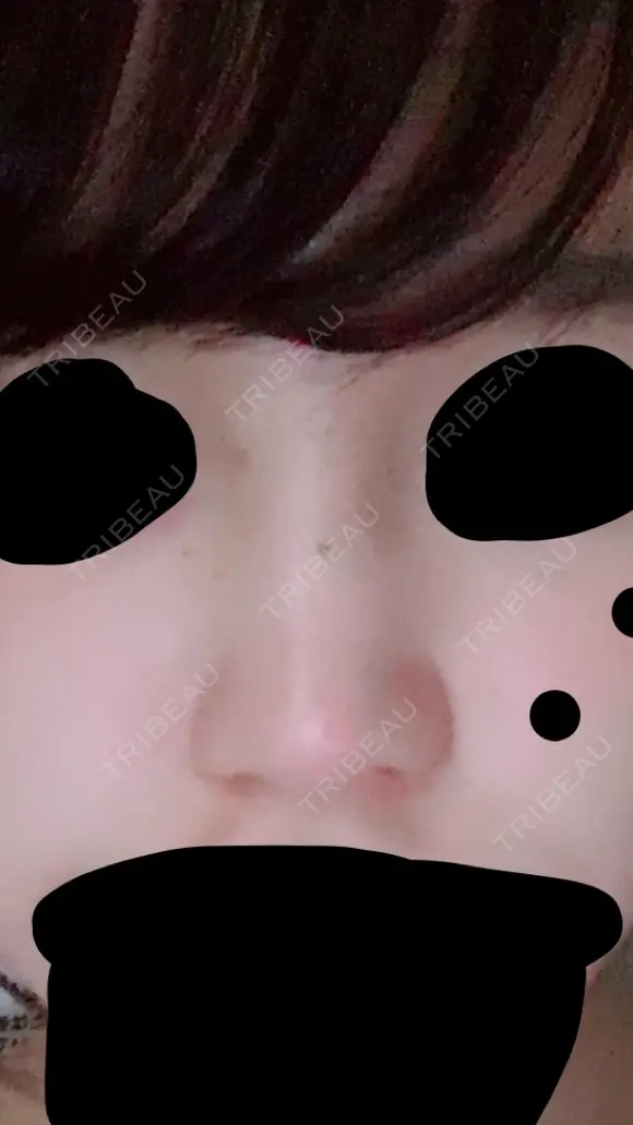 鼻尖形成（切開） 三輪皮フ科形成外科 AFTER メイン用