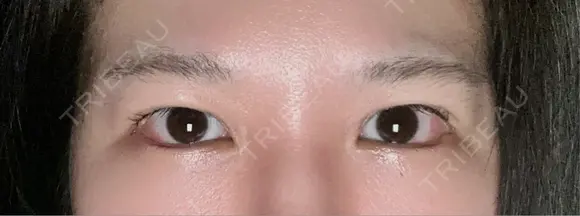 目尻切開 / タレ目形成・グラマラスライン（埋没） LOUIS CLINIC 二子玉川院【ルイクリニック】 DAY 1 メイン用