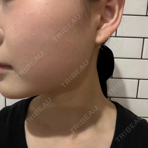 ボトックス（あご） / ボトックス（エラ・小顔） / ボトックス（肩） TCB東京中央美容外科 堺院 DAY 3 メイン用