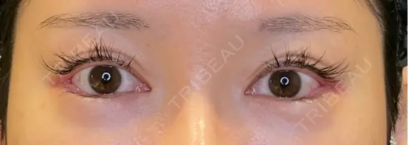 目尻切開 / タレ目形成・グラマラスライン（埋没） / 美容点滴・美容注射（美肌） LOUIS CLINIC 二子玉川院【ルイクリニック】 DAY 5 メイン用