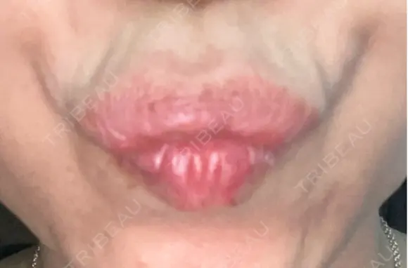 ボトックス（エラ・小顔） / ボトックス（目尻） / ボトックス（人中） 代々木駅前美容クリニック AFTER メイン用