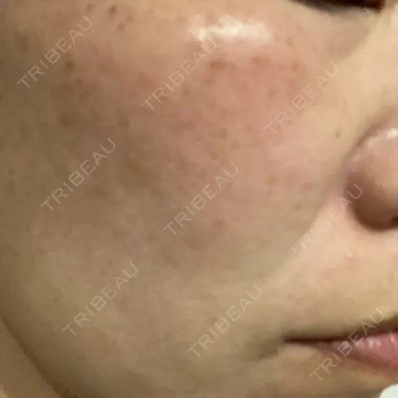 イオン導入 / ルメッカ ルラ美容クリニック 大宮院 / ルラスキンクリニック 大宮院 DAY 2 メイン用