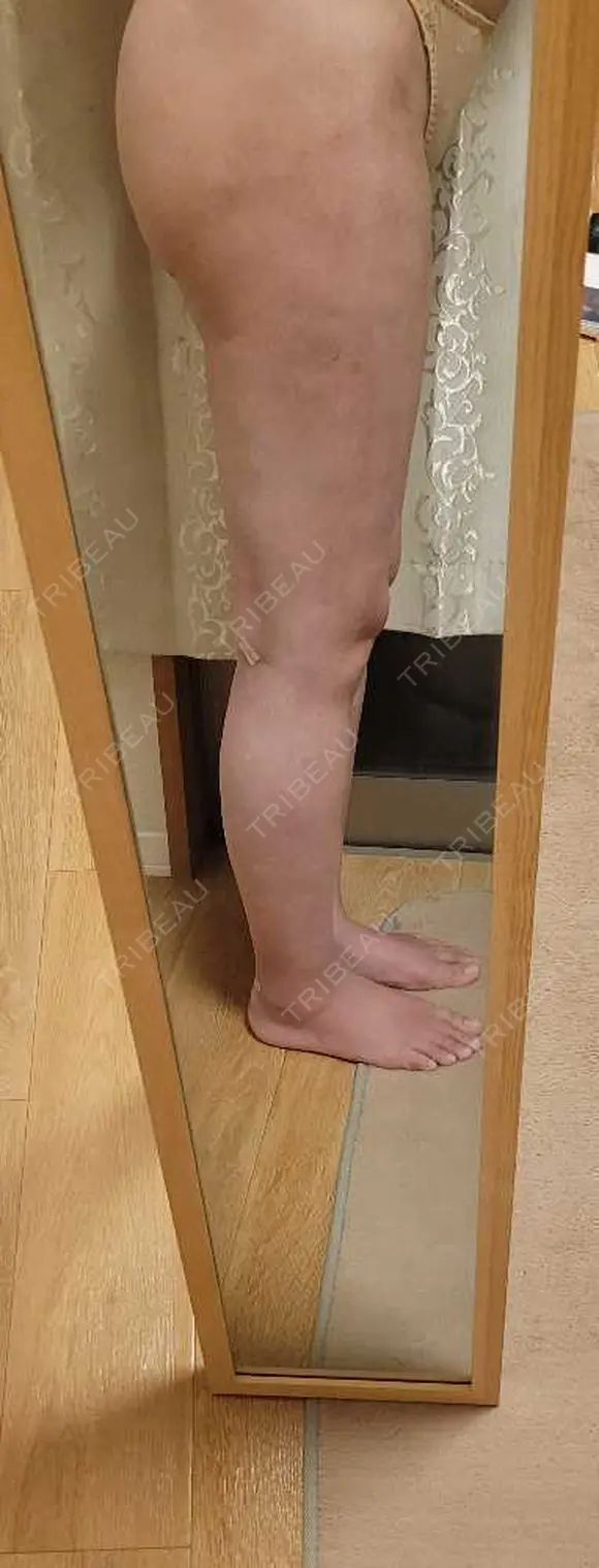 脂肪吸引（お尻） アムルーズ美容外科クリニック 横浜院 DAY 27 メイン用