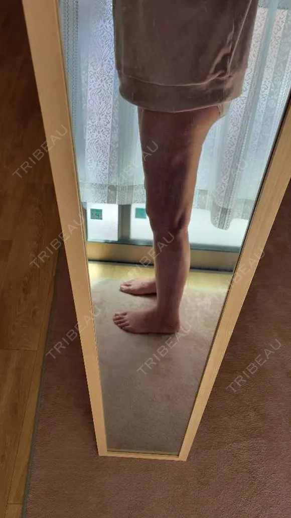 脂肪吸引（お尻） アムルーズ美容外科クリニック 横浜院 DAY 61 メイン用