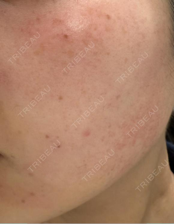 ピーリング（ハリ・ツヤ） / ルメッカ PureMe Skin Clinic（ピュアミースキンクリニック麻布） DAY 0 メイン用