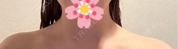 ボトックス（肩） ルラ美容クリニック 札幌本院 DAY 4 メイン用