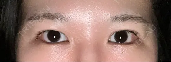 目尻切開 / タレ目形成・グラマラスライン（埋没） LOUIS CLINIC 二子玉川院【ルイクリニック】 DAY 2 メイン用