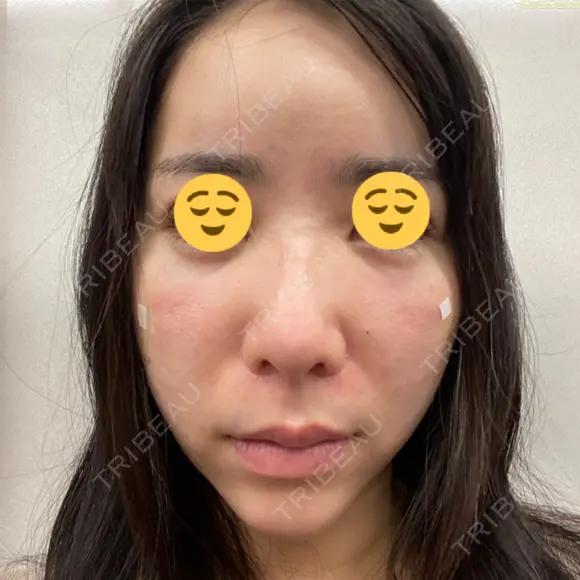 クマ治療 / 脂肪注入（目の下） 藤・ナチュレ美容クリニック 銀座院 DAY 0 メイン用