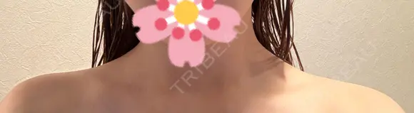 ボトックス（肩） ルラ美容クリニック 札幌本院 DAY 6 メイン用