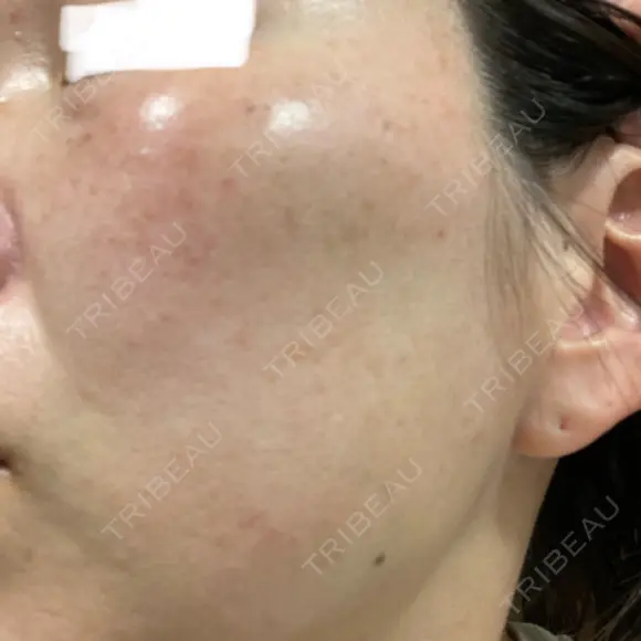 イオン導入 / ルメッカ ルラ美容クリニック 大宮院 / ルラスキンクリニック 大宮院 DAY 4 メイン用