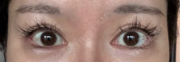 目尻切開 / タレ目形成・グラマラスライン（埋没） / 美容点滴・美容注射（美肌） LOUIS CLINIC 二子玉川院【ルイクリニック】 DAY 6 メイン用