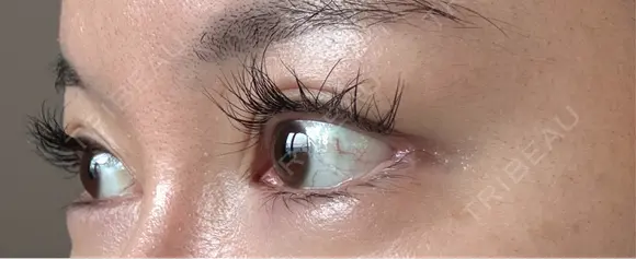 目尻切開 / タレ目形成・グラマラスライン（埋没） / 美容点滴・美容注射（美肌） LOUIS CLINIC 二子玉川院【ルイクリニック】 DAY 6 メイン用