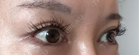 目尻切開 / タレ目形成・グラマラスライン（埋没） / 美容点滴・美容注射（美肌） LOUIS CLINIC 二子玉川院【ルイクリニック】 DAY 6 メイン用