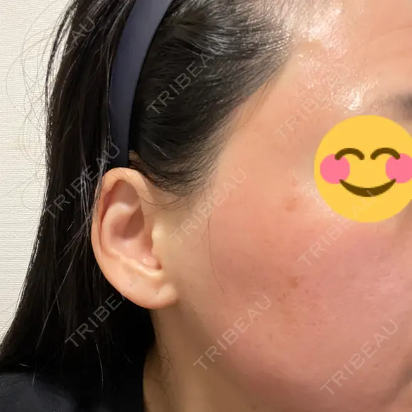 ヴェルヴェットスキン ゆう美容クリニック DAY 0 メイン用