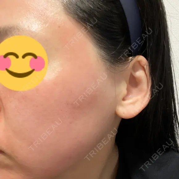 ヴェルヴェットスキン ゆう美容クリニック DAY 0 メイン用