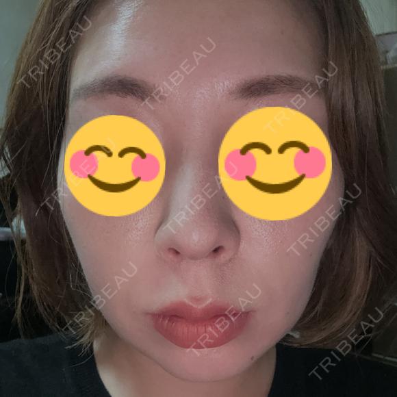 糸リフト / その他（輪郭） PRISM Beauty Clinic 町田院 AFTER メイン用