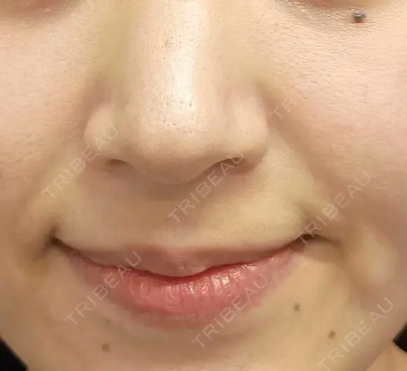 ヒアルロン酸注入（鼻翼基部） eクリニック 大阪院 AFTER メイン用