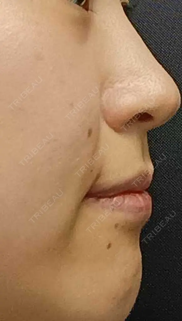 ヒアルロン酸注入（鼻翼基部） eクリニック 大阪院 DAY 0 メイン用