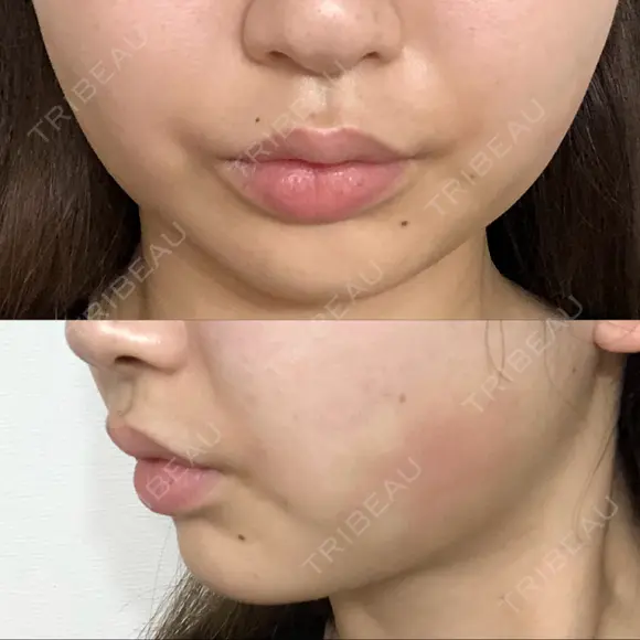 脂肪吸引注射（顔） EMMO FACE CLINIC 東京三田院 AFTER メイン用