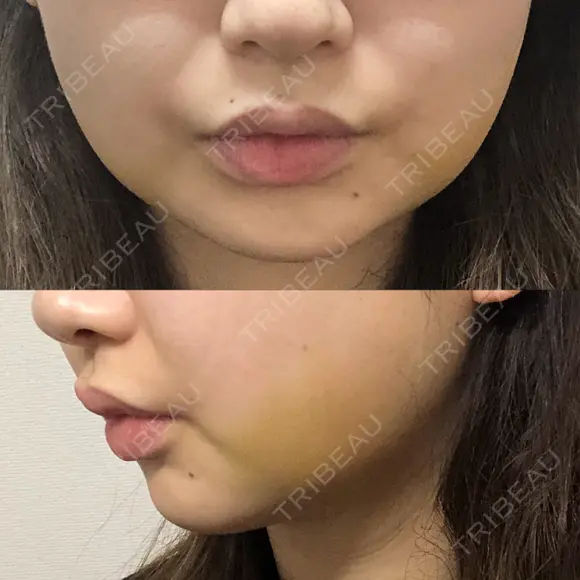 脂肪吸引注射（顔） EMMO FACE CLINIC 東京三田院 DAY 1 メイン用