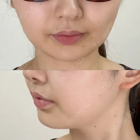 脂肪吸引注射（顔） EMMO FACE CLINIC 東京三田院 DAY 1 メイン用
