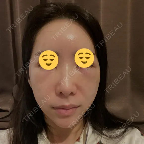 クマ治療 / 脂肪注入（目の下） 藤・ナチュレ美容クリニック 銀座院 DAY 1 メイン用