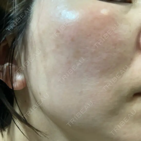 イオン導入 / ルメッカ ルラ美容クリニック 大宮院 / ルラスキンクリニック 大宮院 AFTER メイン用