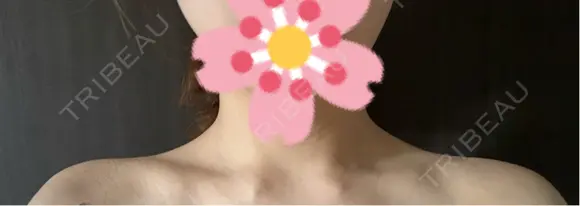 ボトックス（肩） ルラ美容クリニック 札幌本院 DAY 8 メイン用