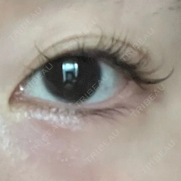 眼瞼下垂（非切開） SOL CLINIC DAY 0 メイン用