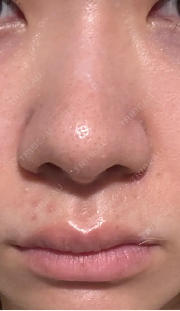 鼻尖形成（切開） / 軟骨移植 / 鼻柱下降・鼻唇角形成（猫手術） 東京美専クリニック DAY 18 メイン用