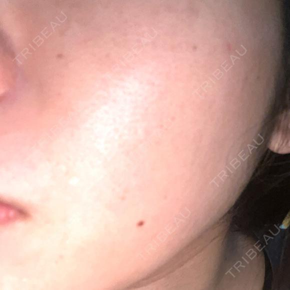 ピーリング（ハリ・ツヤ） / ルメッカ PureMe Skin Clinic（ピュアミースキンクリニック麻布） AFTER メイン用