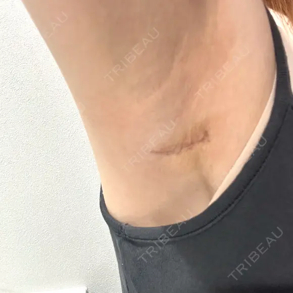 豊胸（シリコンバッグ） / その他（胸） / 乳頭縮小 ルーチェクリニック 銀座院 DAY 24 メイン用