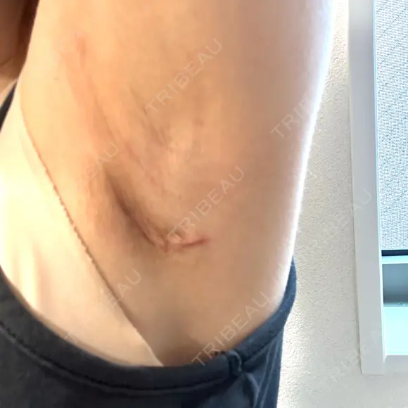 豊胸（シリコンバッグ） / その他（胸） / 乳頭縮小 ルーチェクリニック 銀座院 DAY 24 メイン用