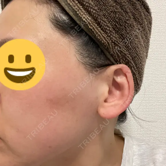 ヴェルヴェットスキン ゆう美容クリニック DAY 3 メイン用