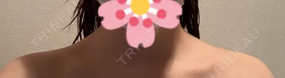 ボトックス（肩） ルラ美容クリニック 札幌本院 DAY 9 メイン用