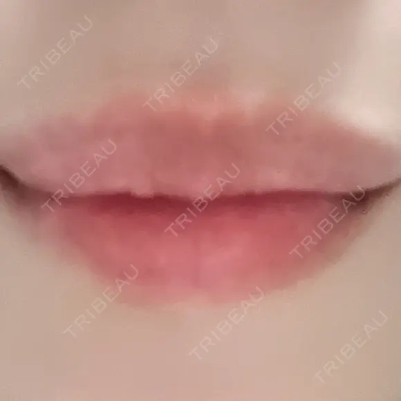 ヒアルロン酸注入（唇） / ヒアルロン酸注入（目の下） KIMI CLINIC 形成・美容外科 AFTER メイン用