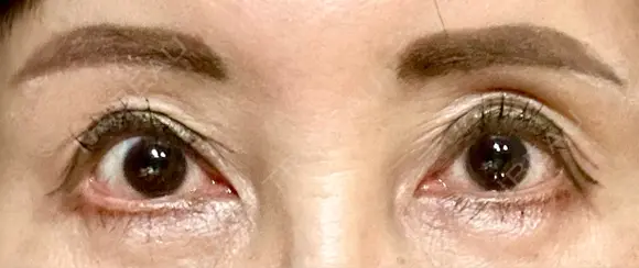 二重切開 / 眼瞼下垂（切開） / 上まぶたたるみ取り / 眉下切開 / 脂肪吸引注射（顔） / 肌ヒアルロン酸注入（たるみ・シワ改善） 東京シンデレラ美容外科 新宿院 AFTER メイン用