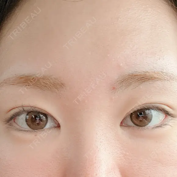 その他（目元） 東京形成美容外科 船橋院 AFTER メイン用