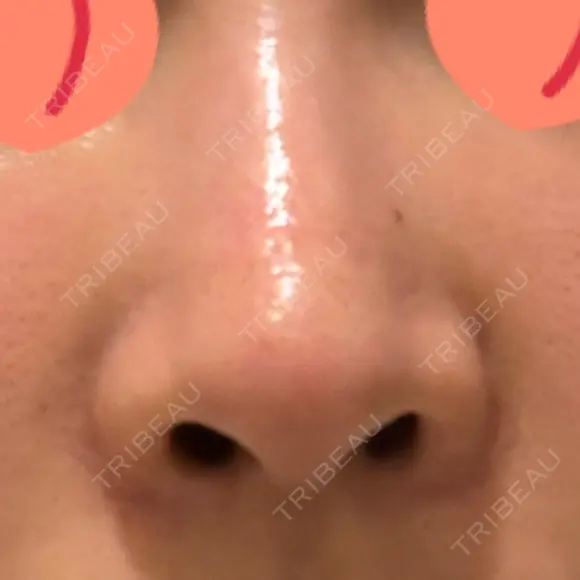 鼻尖形成（切開） / 骨削り（頬） / 軟骨移植 / 鼻孔縁挙上 THE ROPPONGI CLINIC（ザ 六本木クリニック） AFTER メイン用